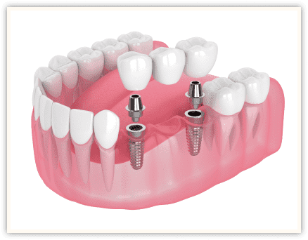dental implants