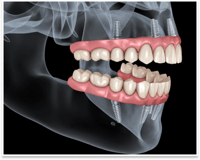 dental implants