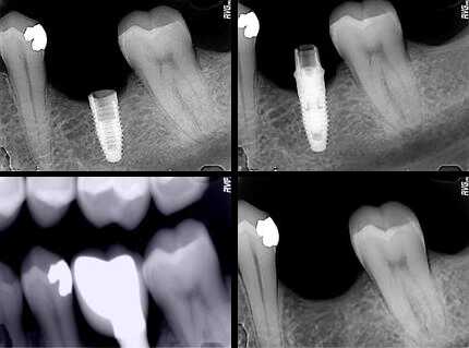 dental implants